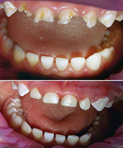 Реставрация молочных зубов Томск Карташова герметизация зубов у взрослых
